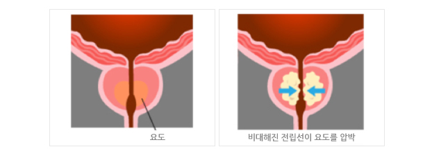 전립선비대증 예시 그림 1