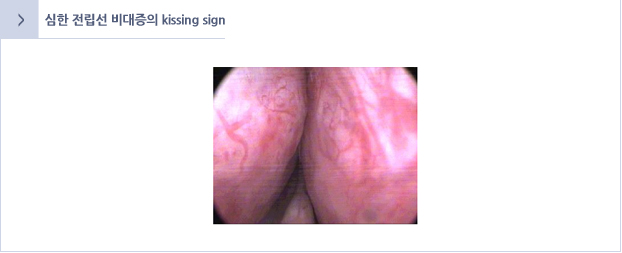 심한 전립선 비대증의 kissing sign